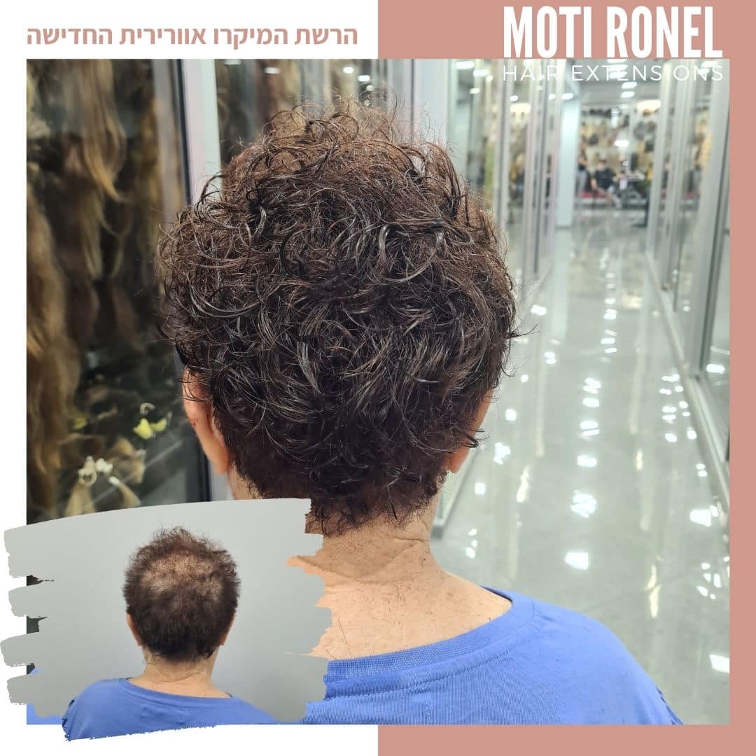 לקוחה שעשינו לה מילוי קבוע של שיער דליל בחלק העליון של הראש בשיטת מיקרוליינס ותספורת קצרה